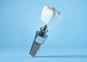 East Dulwich Dental Implants Dentist Offers Consultations at The Gardens Dental Centre