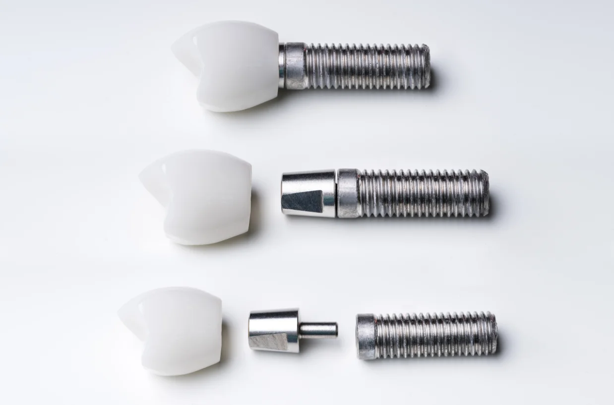 Kidbrooke Dental Implants Dentist Announces Consultations at Kidbrooke Village Dentist (Smile 4 U)