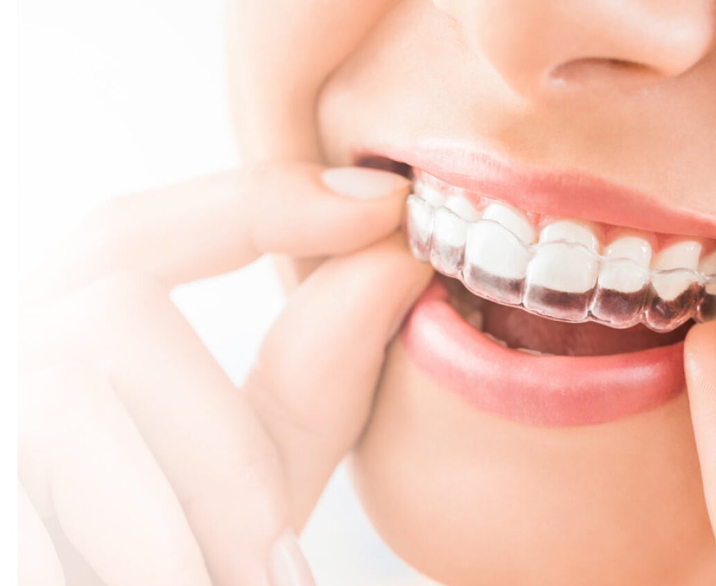 Bradford Wibsey Invisalign Clear Aligners Consultations Announced at Taylored Dental Care