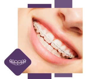 Fixed Braces Hemel Hempstead Teeth Straightening Appointments Available for New Private Patients at Boxmoor House Dental Practice